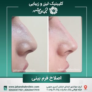 تزریق فیلر بینی کلینیک جهانشهر کرج