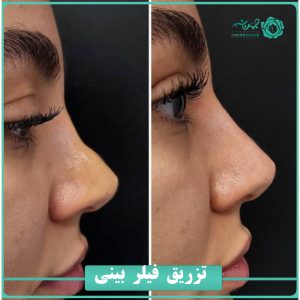 فیلر بینی کلینیک جهانشهر کرج-4