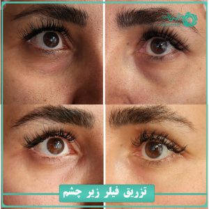 فیلر زیر چشم-جهانشهر کرج-3