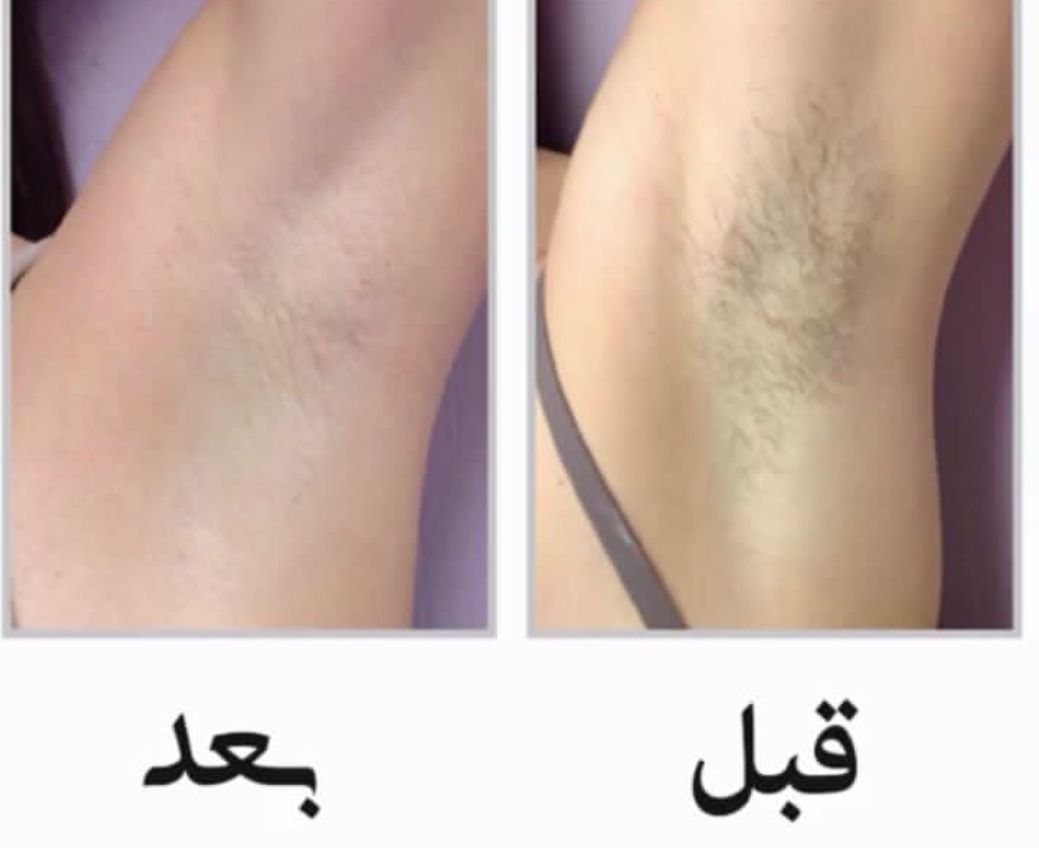 عکس لیزر موهای زائد قبل و بعد کرج