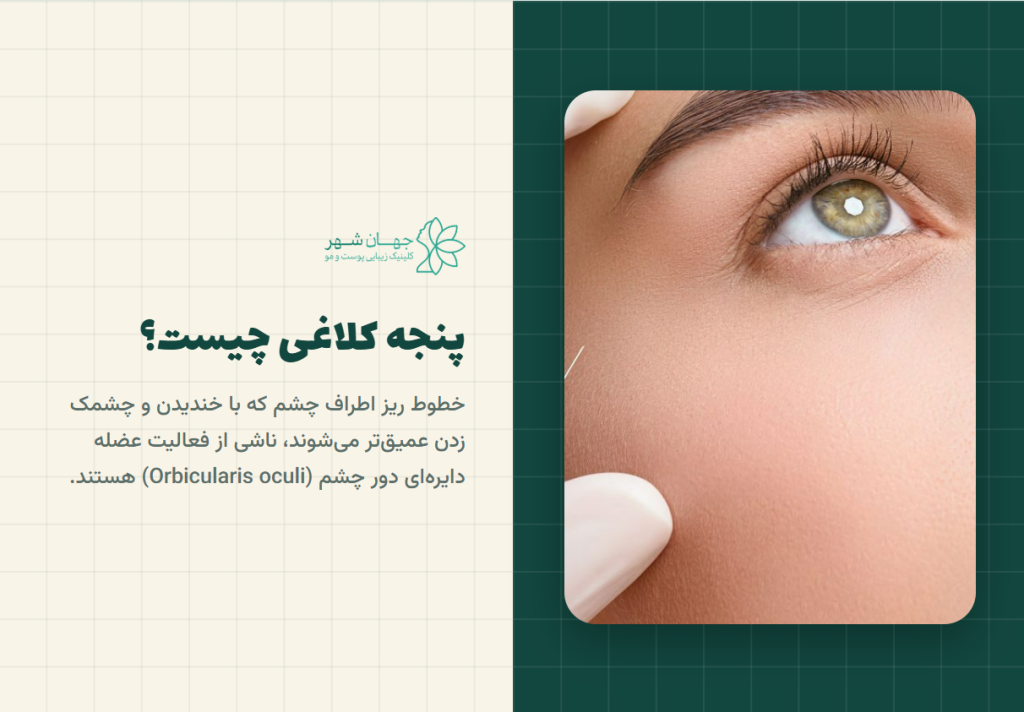 بوتاکس دور چشم چیست و آناتومی آن چگونه است